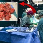 55 Kiloluk Kadının Rahminden 17 Kiloluk Dev Miyom Çıkarıldı! Doktorlar Bile Şaşkına Döndü