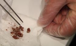 Elazığ’da estetik ameliyatta şaşırtan olay, burundan taş çıktı