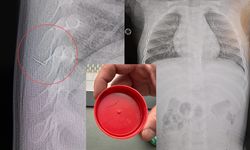 Kahramanmaraş’ta bebeğin sırtından 2 cm’lik tel parçası çıkarıldı