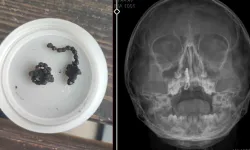 5 Yaşındaki Çocuğun Burnundan 2 Yıl Sonra Tırnak Makası Zinciri Çıkarıldı