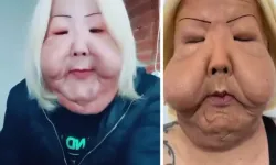 Güzellik uğruna yüzü tanınmaz hale geldi!