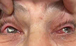 Bu otun kullanımına dikkat: "Gözlerine suyunu damlattı, göremez hale geldi"