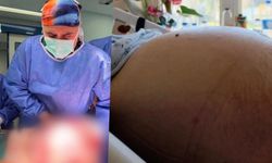 Doktorları Şaşkına Çeviren Vaka: Kabızlık Sandı, Karnından 22 Kiloluk Tümör Çıktı