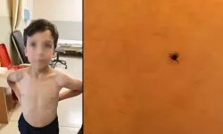 7 yaşındaki Mustafa'nın göğsüne kene yapıştı