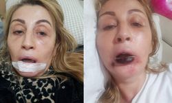 Estetik işlem sonrası dudağını kaybetti! 7 yıllık hukuk savaşı