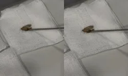 Kulağından canlı kelebek çıkarıldı! Doktor bile şaşkınlığını gizleyemedi