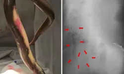 Makatından Giren Canlı Yılan Balığı Ameliyatla Çıkarıldı!