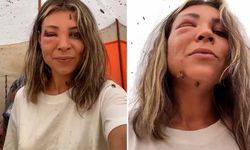 2200 rakımda arıların saldırısına uğradı! Yüzünün son hali şaşkına çevirdi
