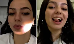 Yeni estetik akımı şaşkına çevirdi! Genç kadın “vampir dişi” yaptırdı