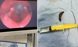 Çeşmeden su içti, 2 hafta sonra boğazından canlı sülük çıktı!