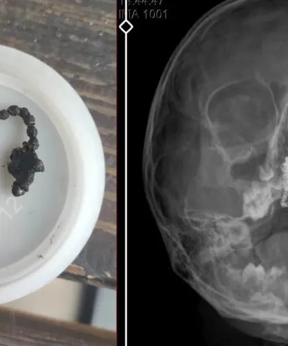 5 Yaşındaki Çocuğun Burnundan 2 Yıl Sonra Tırnak Makası Zinciri Çıkarıldı