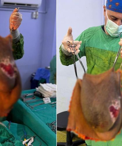 67 Yaşındaki Kadının Karnından 40 Kiloluk Kitle Çıktı