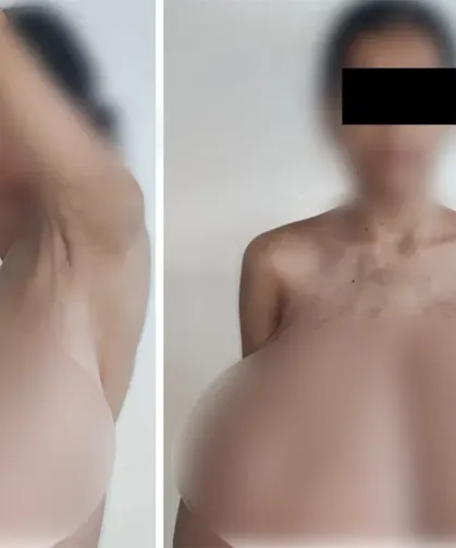 13 Yaşında Başladı! Göğüsleri 16,5 Kiloya Ulaşan Genç Kızın Hayatı Değişti