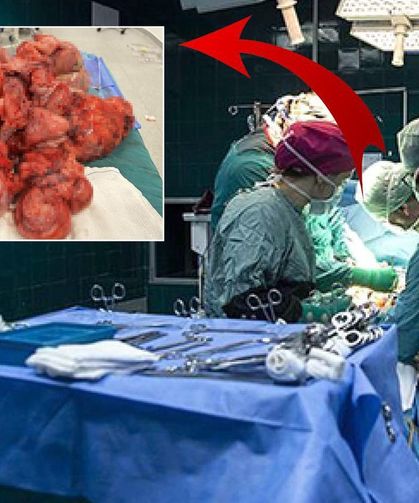 55 Kiloluk Kadının Rahminden 17 Kiloluk Dev Miyom Çıkarıldı! Doktorlar Bile Şaşkına Döndü