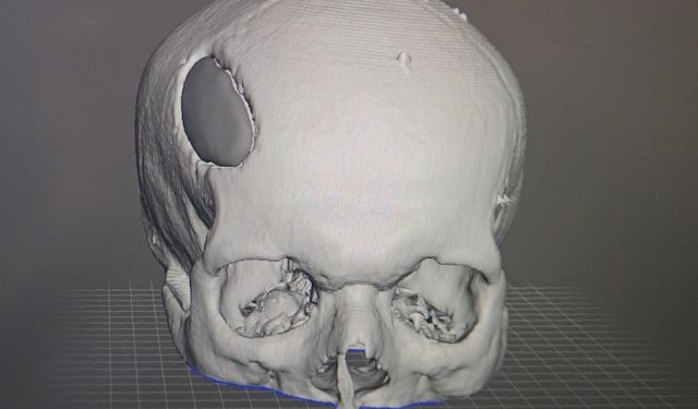 Osmaniye'de ilk kez 3D yazıcı tekniğiyle kafatası ameliyatı