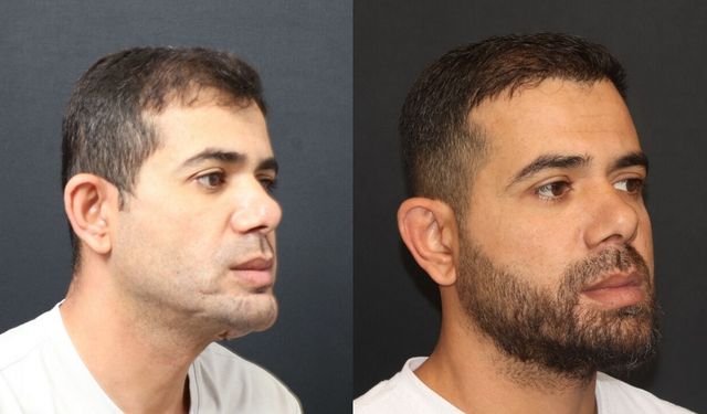 Ateşli silahla çenesini kaybetmişti: Zorlu operasyonla hayata döndü