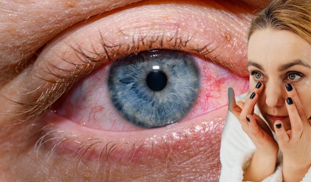 Mevsimsel Göz Alerjileri Göz Sağlığını Tehdit Ediyor