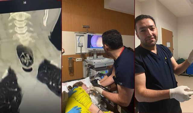 Ağrı’da yuttuğu ceviz yemek borusundan çıkarıldı