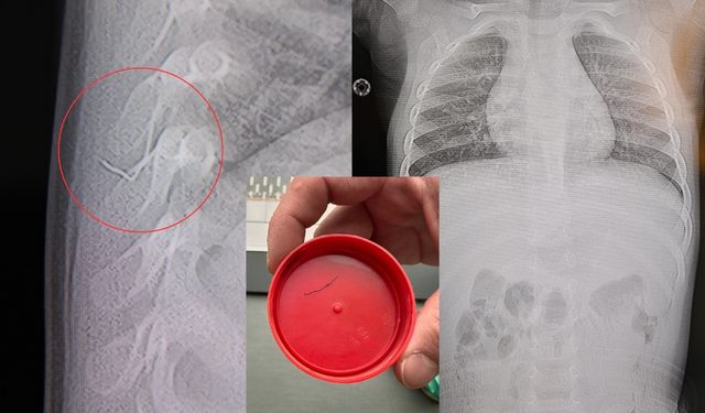 Kahramanmaraş’ta bebeğin sırtından 2 cm’lik tel parçası çıkarıldı