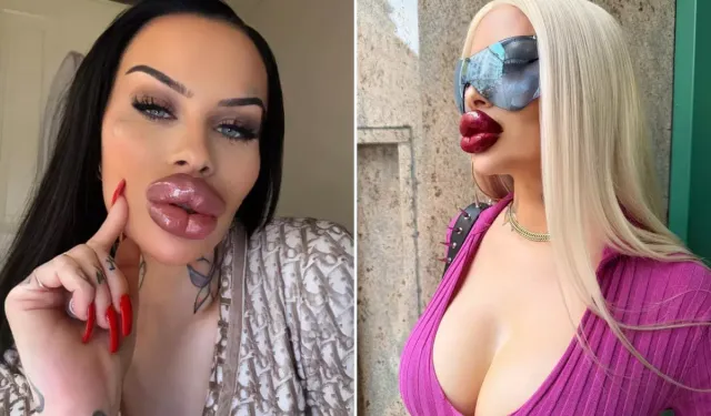 60 Bin Dolarlık Estetik Bağımlılığı: Artık Dudaklarını Kapatamıyor