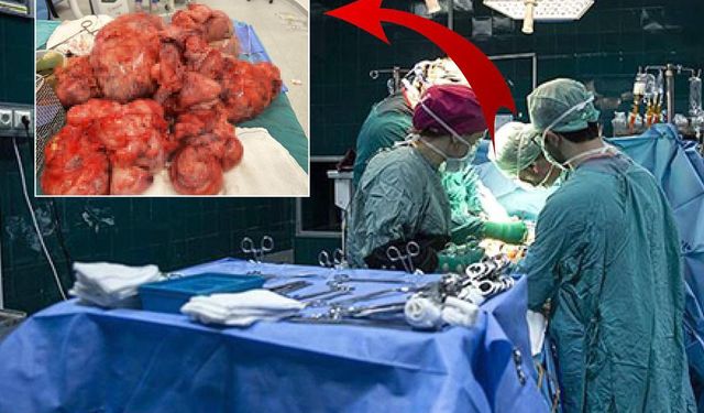 55 Kiloluk Kadının Rahminden 17 Kiloluk Dev Miyom Çıkarıldı! Doktorlar Bile Şaşkına Döndü