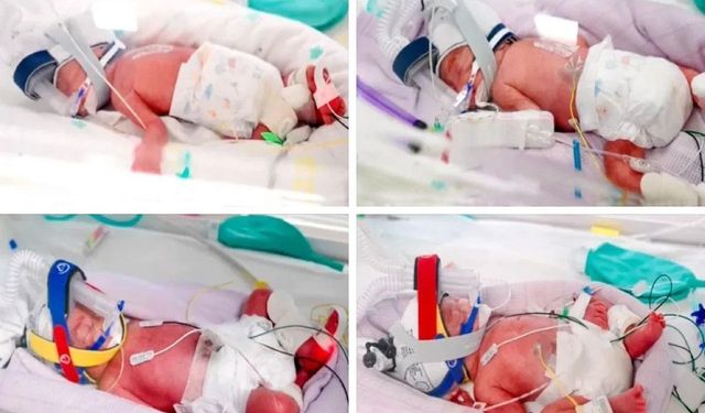 Uzmanları Bile Şaşırttı! 15 Milyonda Bir Görülen Gebelik Gerçekleşti