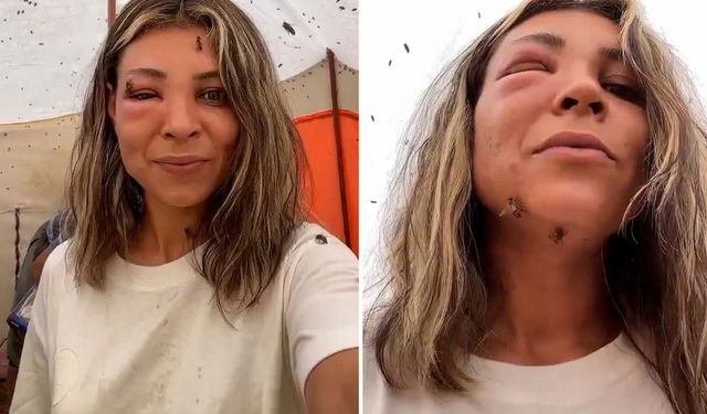 2200 rakımda arıların saldırısına uğradı! Yüzünün son hali şaşkına çevirdi