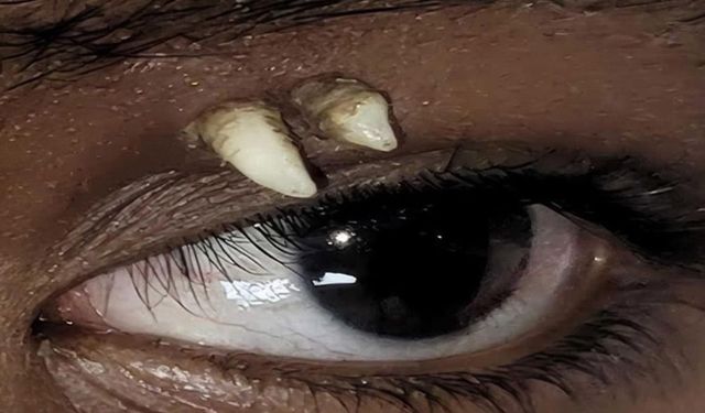 16 Yaşındaki Çocuğun Göz Çukurunda Köpek Dişi Bulundu