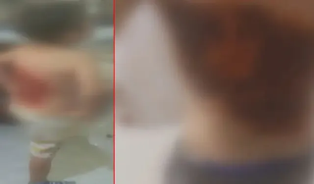 12 yaşındaki Batuhan'ın sırtına kolonya döküp yaktılar