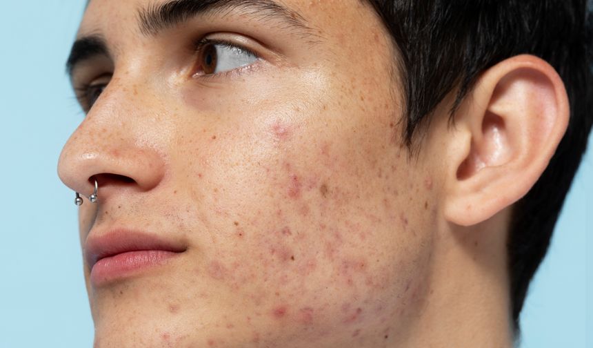 Akne Nedir? Neden Olur? Kalıcı Çözümler ve Akne Tedavisi