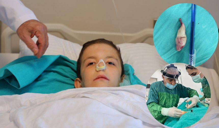 Kahramanmaraş'ta tıp dünyasını şaşırtan dev polip vakası