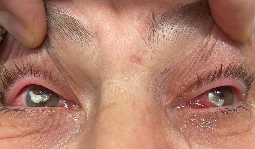 Bu otun kullanımına dikkat: "Gözlerine suyunu damlattı, göremez hale geldi"