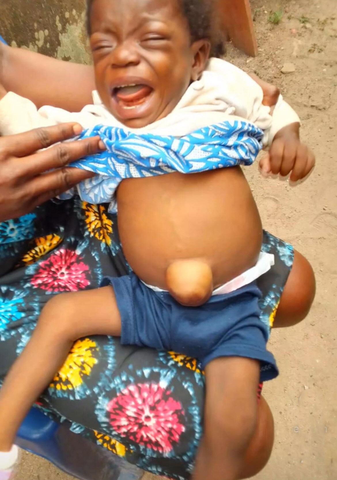 Antalya’da Başarılı Karaciğer Nakliyle Nijeryalı Minik Mercy’nin Umut Yolculuğu (4)