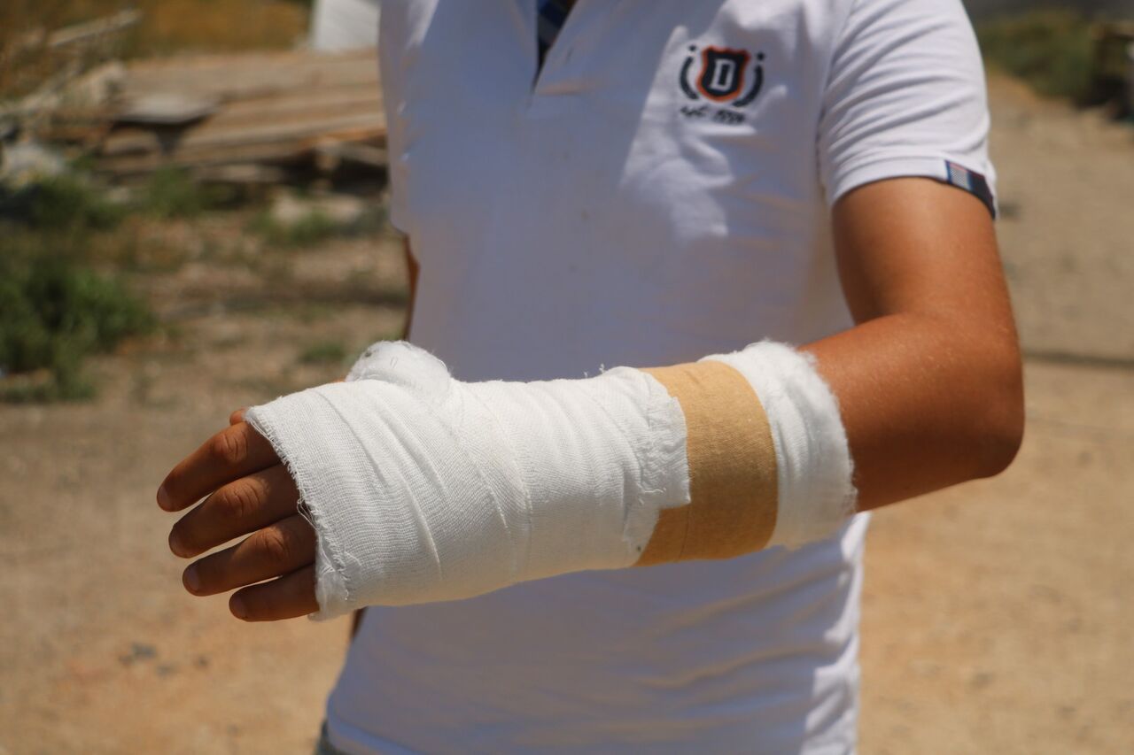 Evini Alevlerden Kurtarmaya Çalışırken Eli Kırıldı Hataylı Gencin Fedakârlığı Yürek Burktu (3)