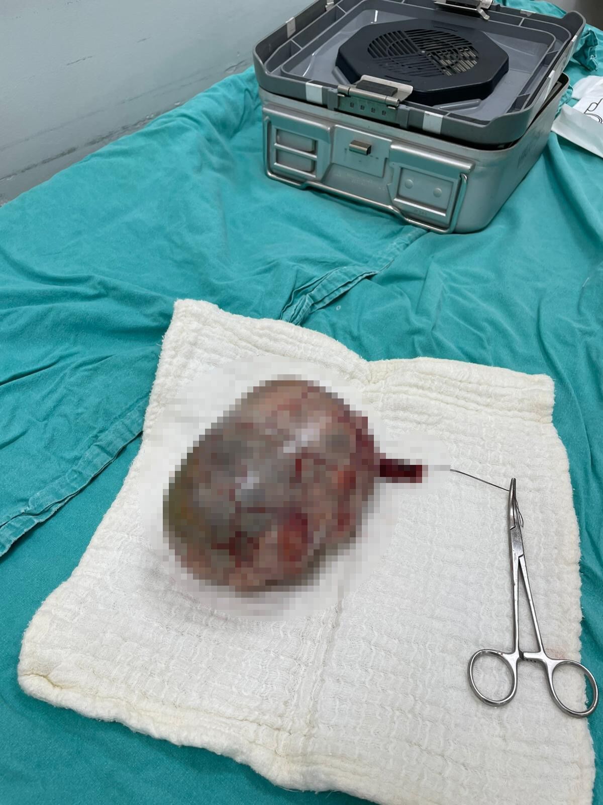 Kahramanmaraş’ta Testisinde 20 Cm Tümör Tespit Edilen Hasta Ameliyat Edildi (1)