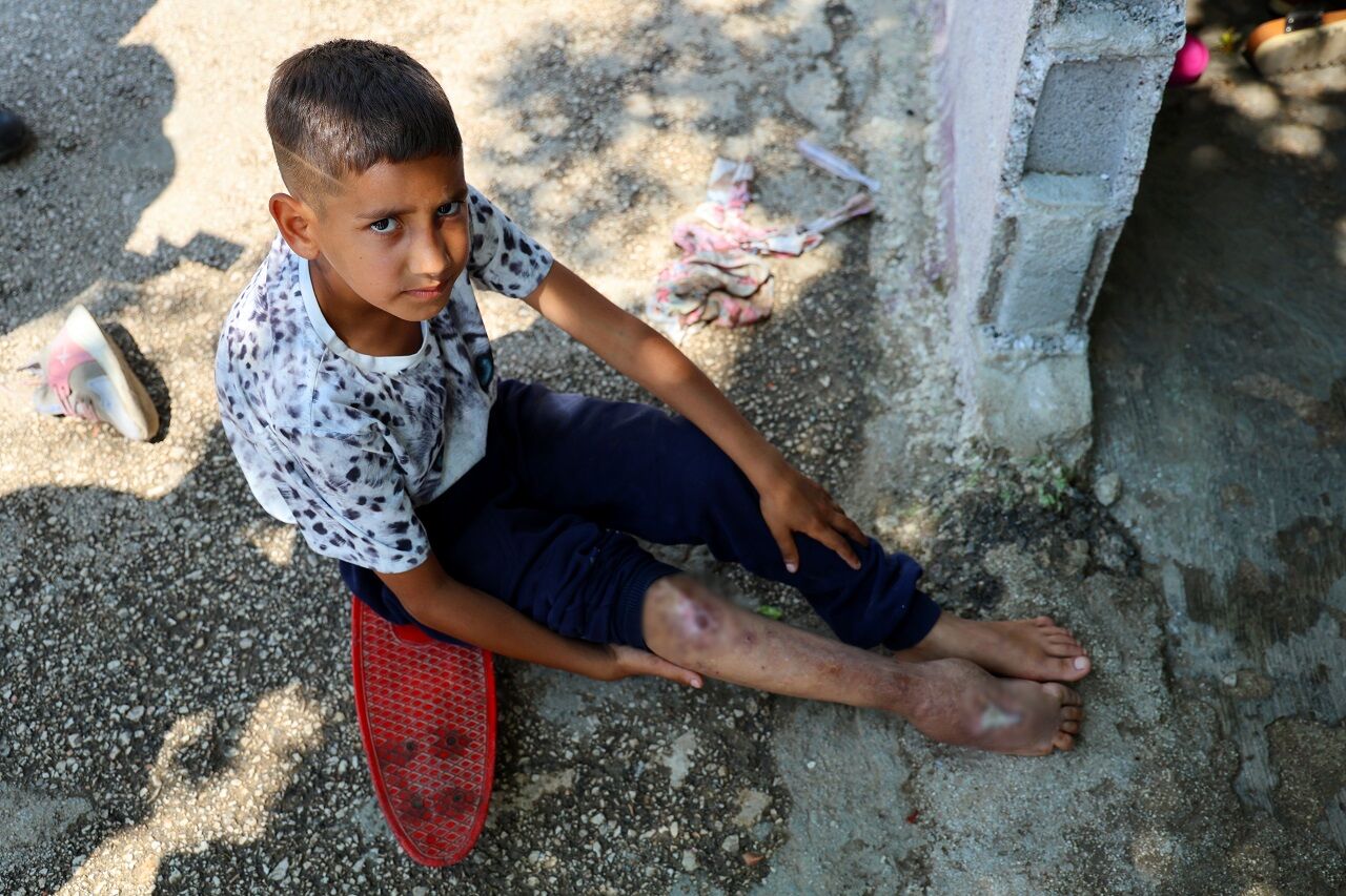 Kaza Sonrası Ayağı Yanlış Kaynadı, Hayatı Kaykay Üzerinde Geçiyor (1)