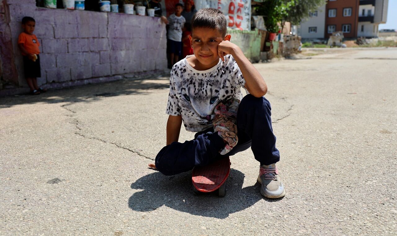 Kaza Sonrası Ayağı Yanlış Kaynadı, Hayatı Kaykay Üzerinde Geçiyor (3)