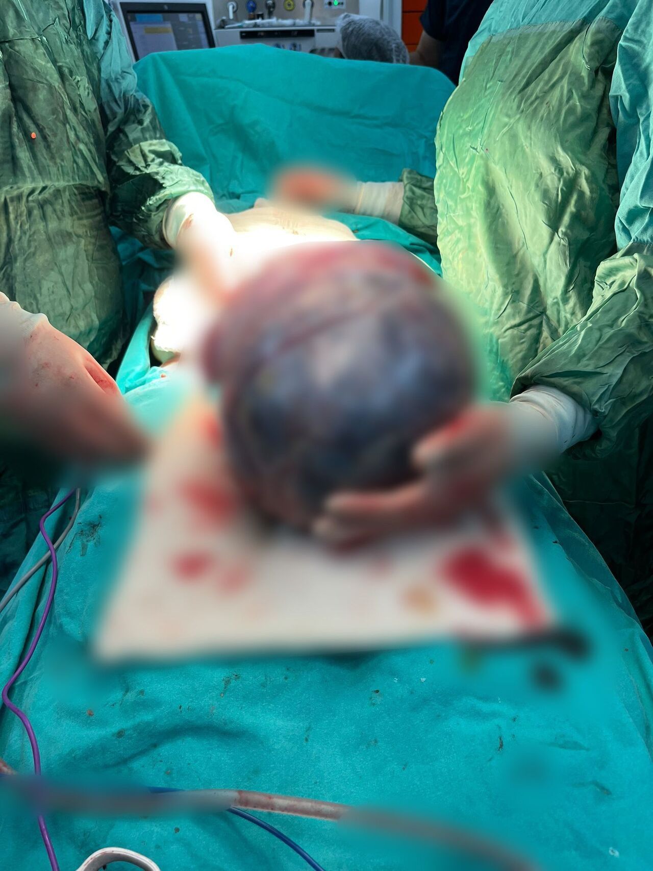 Kahramanmaraş'ta Dev Kitle Operasyonu Hastanın Karnından 40 Santimetrelik Tümör Çıktı (4)