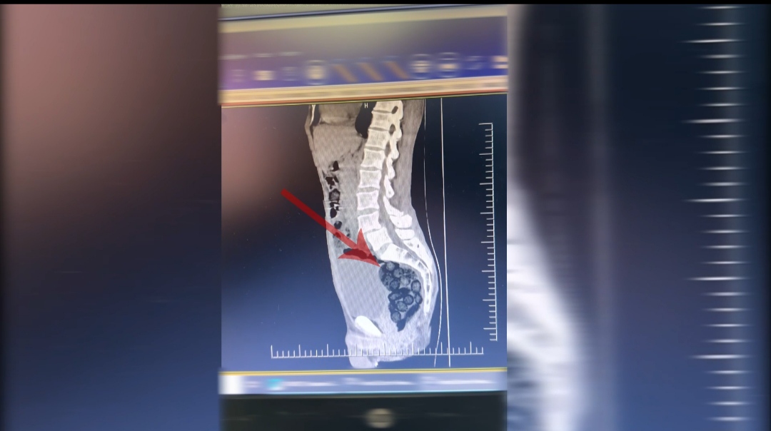 Şüpheli Yolcunun Midesinden 472 Gram Metamfetamin Çıktı (1)