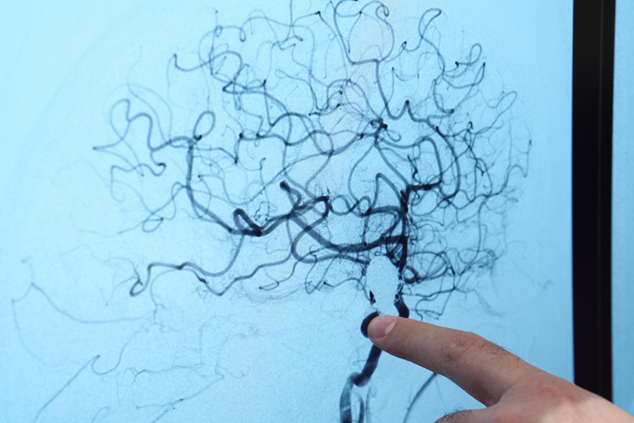 Beyin Anevrizmasında Ölüm Riski Yüzde 50’Ye Çıkabiliyor (1)