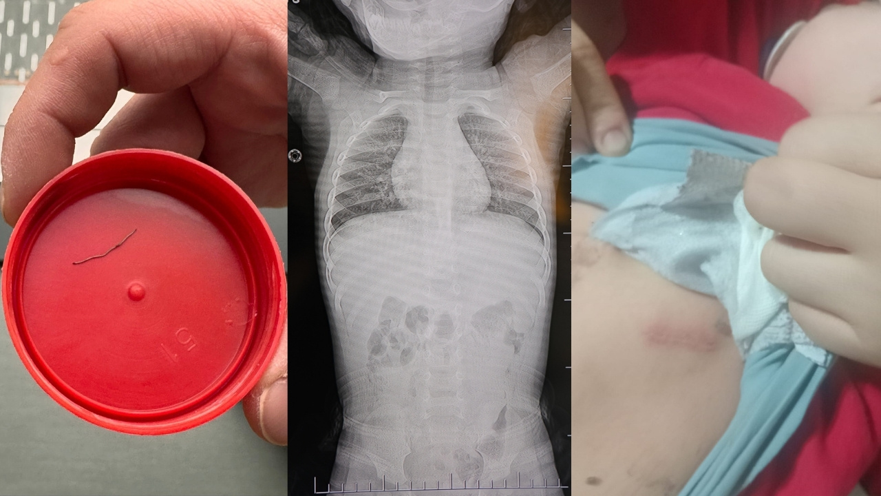 Kahramanmaraş’ta 1 Yaşındaki Bebeğin Belinden Zımba Teli Çıktı, Aile Adalet Peşinde (4)