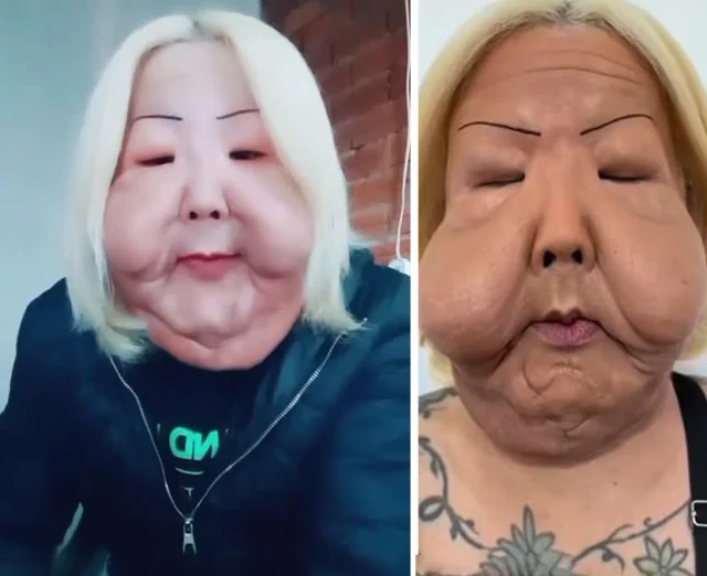 Güzellik uğruna yüzü tanınmaz hale geldi!