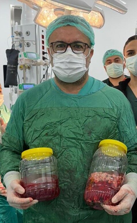 Kahramanmaraş’ta Kilo Kaybı Şikayetiyle Gitti, Böbreğinden 20 Santimlik Dev Tümör Çıktı (2)