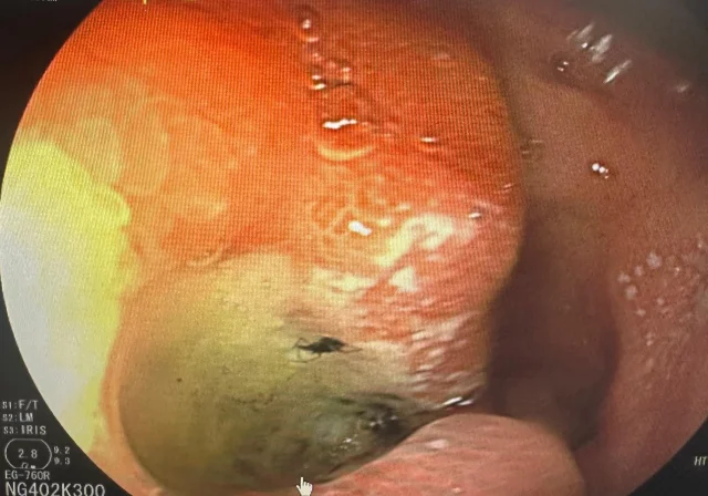 Doktorlar Bile Şaşırdı! Midesinden Canlı Böcek Çıktı (1)