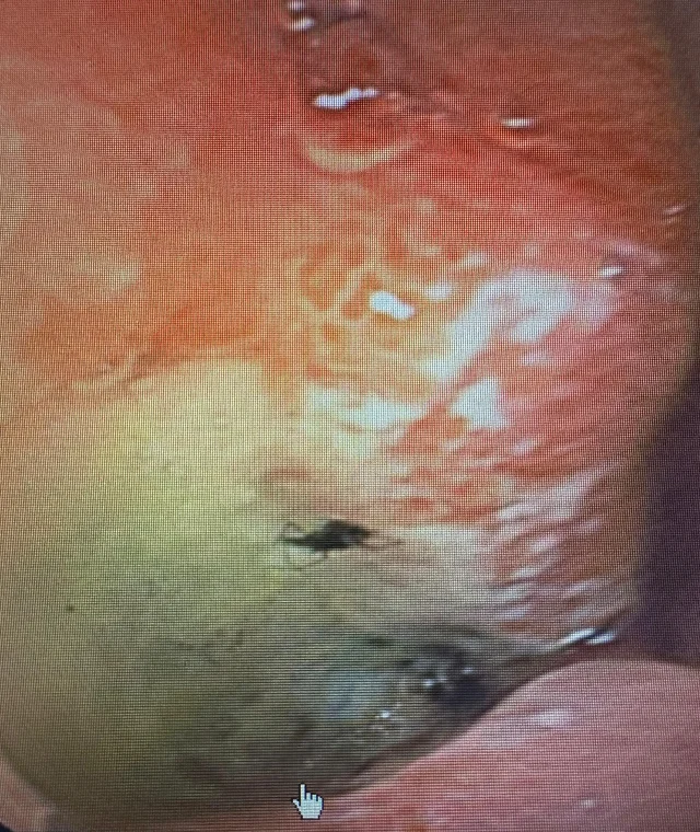 Doktorlar Bile Şaşırdı! Midesinden Canlı Böcek Çıktı (4)