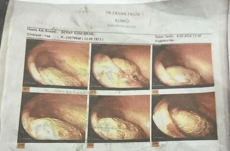 Ameliyatta Gazlı Bez Unutulduğu Iddiasıyla 2 Doktor Hakkında Dava