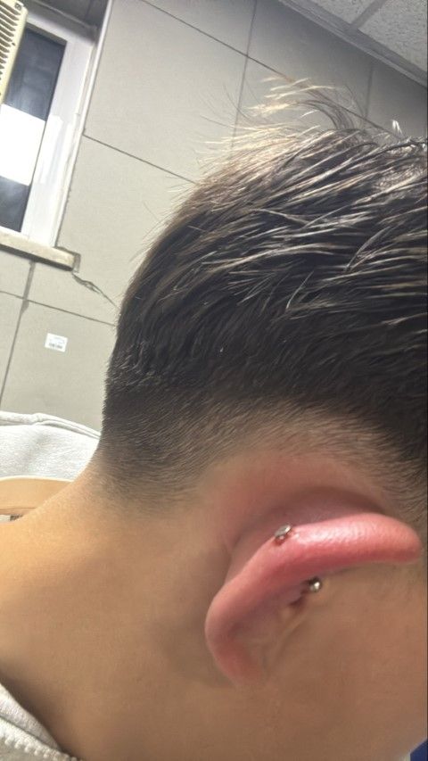 Bursa’da Piercing Kabusu; Kulağı Şişen 17 Yaşındaki Çocuk Hastanelik Oldu